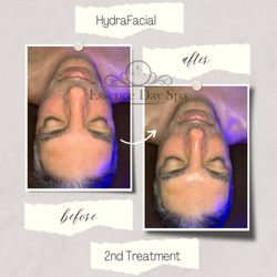Essence Day Spa - We offer a variety of skincare services. Our personal favorite with instant results is our HydraFacial!