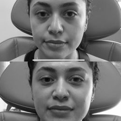 Peaktox - Undereye Filler