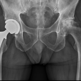 Justin P. Than, DO - Anterior Hip Replacement - Orthopedists Near Me - Lodi, California