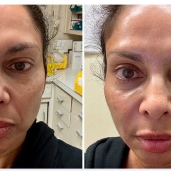 NakedMD - Ezgel in the nasal labial fold - Medical Spas Near Me - Santa Monica, California NakedMD - Ezgel in the nasal labial fold - Medical Spas Near Me - Santa Monica, California