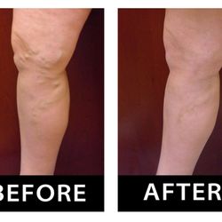 Center for Vein Restoration | Dr. Victor Medina - Before and After Treatment