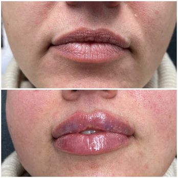 PrimaVera - Russian Lips - Tattoo Removal Near Me - Culver City, California PrimaVera - Russian Lips - Tattoo Removal Near Me - Culver City, California