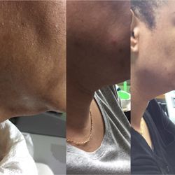 Ultherapy before and after