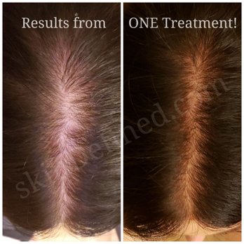 skinDefined - Losing HAIR???
We can get it GROWING back!!!
Book your appointment today! - Medical Spas Near Me - Phoenix, Arizona skinDefined - Losing HAIR???
We can get it GROWING back!!!
Book your appointment today! - Medical Spas Near Me - Phoenix, Arizona
