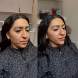 Cheek and chin filler in Grapevine at Just Wellness.