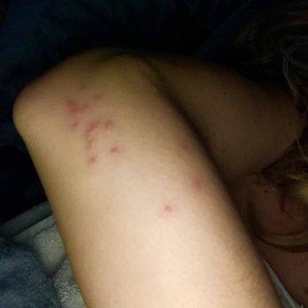 Walnut Creek Marriott - Bed bugs bites :-( - Hotels Near Me - Walnut Creek, California Walnut Creek Marriott - Bed bugs bites :-( - Hotels Near Me - Walnut Creek, California