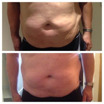 Flow Cryotherapy - CryoSlimming- Male before and after - Cryotherapy Near Me - Salinas, California