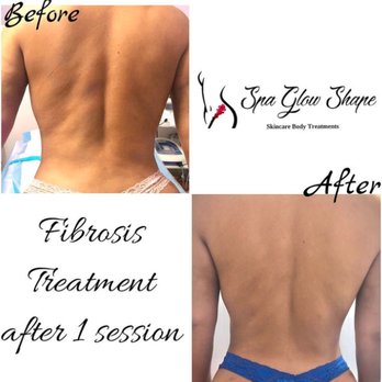 Spa Glow Shape - Before & After only 1 session of fibrosis back treatment - Massage Near Me - Los Angeles, California