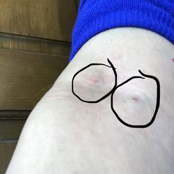 Cardiovascular Care - Two injection sites. No warning of injection. Phlebotomist denis injecting twice. Office manager denies it as well.