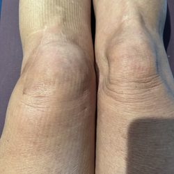 Panorama Orthopedics & Spine Center - Highlands Ranch - Left knee swelling