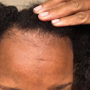 BeautiAccess - I had a widows peak... that's gone, edges just gone! My hairline is pink, that's how bad the hair loss is, painful too! - Hair Stylists Near Me BeautiAccess - I had a widows peak... that's gone, edges just gone! My hairline is pink, that's how bad the hair loss is, painful too! - Hair Stylists Near Me