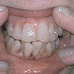 Mark McClure, DDS - Before Six Month Smiles