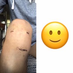 Tru Physical Therapy - A healthy rehabbed knee is a happy knee, thanks Skyler!