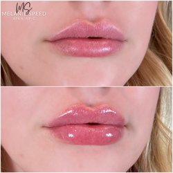 The Beverly Hills Medspa - Before and after lip augmentation by Melanie Speed, APRN, NP-C