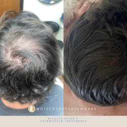 Discovery Skinworks - Results after 3/6 treatments of our unique, science-driven hair restoration and preservation program - Hairworks.