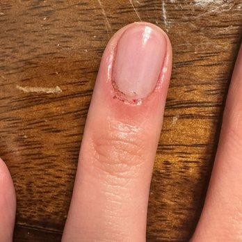Luss Nail Bar - Amherst - Manicure with cut cuticle. Several hours after the bleeding stopped - Nail Salons Near Me - Amherst, New York Luss Nail Bar - Amherst - Manicure with cut cuticle. Several hours after the bleeding stopped - Nail Salons Near Me - Amherst, New York