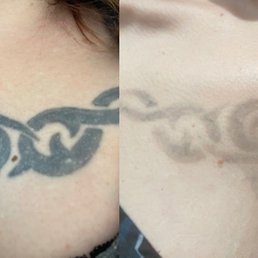 9 of 10 laser tattoo removal sessions - wow! 9 of 10 laser tattoo removal sessions - wow!