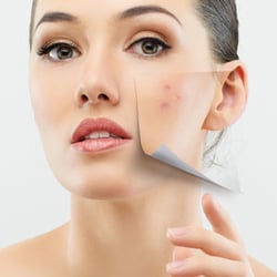 Santa Cruz Med Spa - Laser Acne Treatments