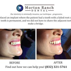 Morton Ranch Dental - Need an implant? We have an implant special going on. $2100 for the implant, crown, and abutment.
