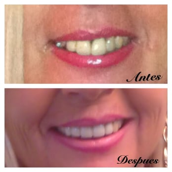 Shoker Devinder, DDS - Doctor Shoker's great work - General Dentistry Near Me - Milpitas, California Shoker Devinder, DDS - Doctor Shoker's great work - General Dentistry Near Me - Milpitas, California
