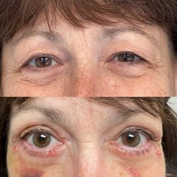 Samir S Undavia, MD - Immediate upper and lower eyelid Blepharoplasty before and after