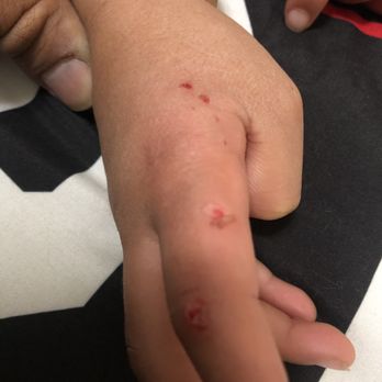 Sugar Pine Doodles - SPD dog bit my 5.5 year old son aggressively on the hand and punctured the skin in ten spots. - Pet Breeders Near Me Sugar Pine Doodles - SPD dog bit my 5.5 year old son aggressively on the hand and punctured the skin in ten spots. - Pet Breeders Near Me