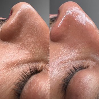 Glow & Tell Aesthetics - Basic facial with extractions - Skin Care Near Me Glow & Tell Aesthetics - Basic facial with extractions - Skin Care Near Me
