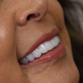 Revive Dental - A close up of a happy patient's smile at Revive Dental - General Dentistry Near Me - Fort Lauderdale, Florida Revive Dental - A close up of a happy patient's smile at Revive Dental - General Dentistry Near Me - Fort Lauderdale, Florida