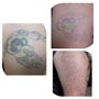 Photo of Out of Ink Laser Tattoo Removal