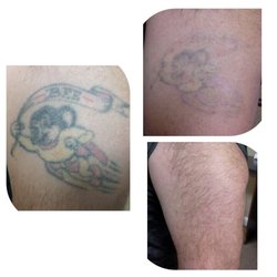 Out of Ink Laser Tattoo Removal - Another successful removal!