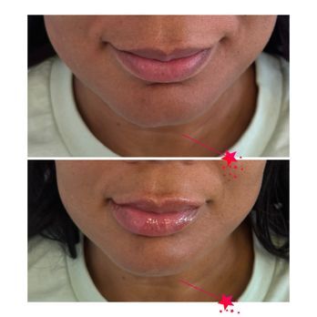 Diamond Med Spa - Correction of cleft chin with fillers - Medical Spas Near Me - Miami Beach, Florida Diamond Med Spa - Correction of cleft chin with fillers - Medical Spas Near Me - Miami Beach, Florida