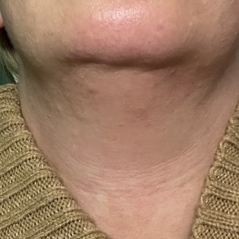 Cosmed Laser Spa - Bumps from the inside out. Not outer acne - Laser Hair Removal Near Me - Brooklyn, New York