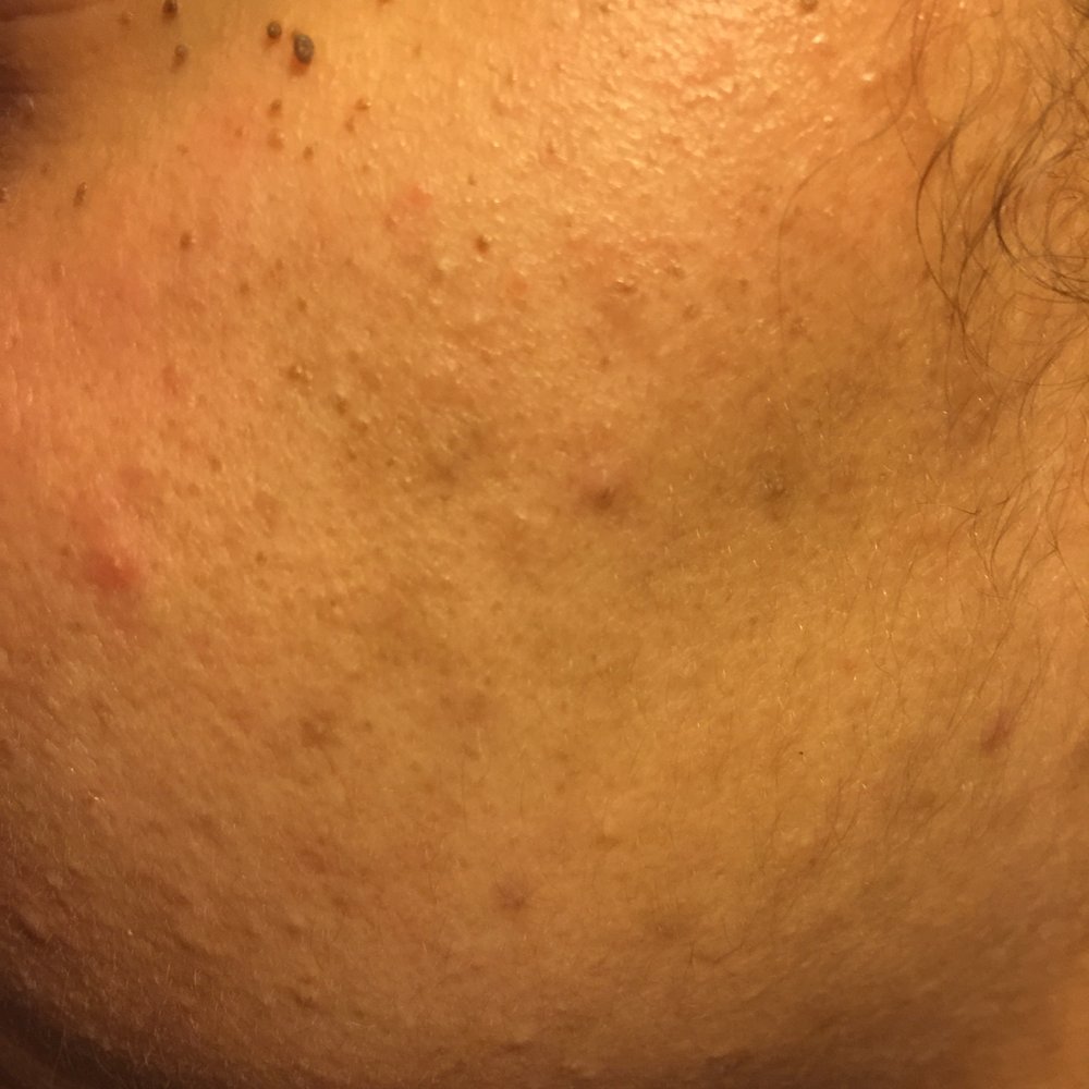 Rejuvenate Spa NY - horrible facial done at this place - Skin Care Near Me - The Bronx, New York