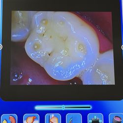 Dentist of Lake Mary - Holes in teeth from grinding worn down to 2nd layer of tooth