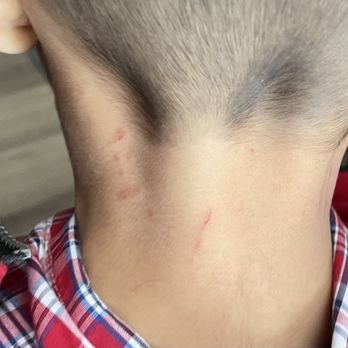 Diesel Barbershop Oneida St - Scratches on my son's neck. - Barbers Near Me - Ashwaubenon, Wisconsin Diesel Barbershop Oneida St - Scratches on my son's neck. - Barbers Near Me - Ashwaubenon, Wisconsin