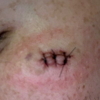 True Dermatology - 4 days after my procedure - Dermatologists Near Me - Anaheim, California True Dermatology - 4 days after my procedure - Dermatologists Near Me - Anaheim, California