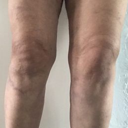 my pain-filled legs before Dr. Amron's procedures my pain-filled legs before Dr. Amron's procedures