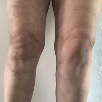 David Amron, MD - my pain-filled legs before Dr. Amron's procedures - Dermatologists Near Me - Beverly Hills, California David Amron, MD - my pain-filled legs before Dr. Amron's procedures - Dermatologists Near Me - Beverly Hills, California