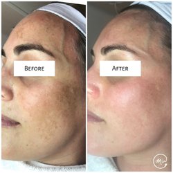 The Modern Ū - New skin for this beauty! Here's what we've corrected: sun damage, melasma, milia, fine lines & wrinkles