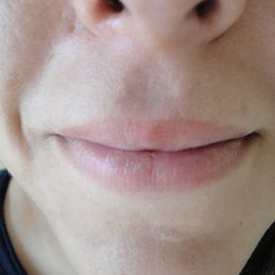 Silky Skin Spa - 100% hair reduction on upper lip