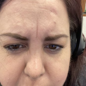 Facial Mania Med Spa - Kendall - Before showing all my defects but my double chin. Which is what I hated the most! - Medical Spas Near Me - Miami, Florida