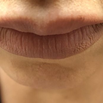 It's a Secret Med Spa - Over 1 month later: Lumpy, asymmetrical, upper lip and overfilled in the center-looks like I was punched in the mouth! - Medical Spas Near Me - Dallas, Texas