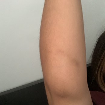 GoJump Oceanside - Bruising on one arm - Skydiving Near Me - Oceanside, California