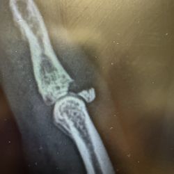 MEDcare Urgent Care - West Columbia - Broken part of the bone, chipped off. They gave me a dvd for my ortho and let me take a pic of the screen for myself.