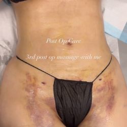 Pure Youth Aesthetics - Clients 2nd round of liposuction 360, 3rd massage with me.