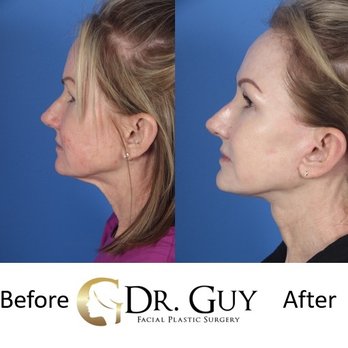 Dr Guy Facial Plastic Surgery - Deep plane facelift - Plastic Surgeons Near Me - Conroe, Texas