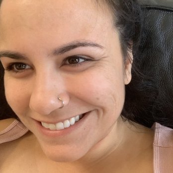 Confident Complexion Skin Care - Day 7 of peel. No makeup, clear difference - Acne Treatment Near Me - San Diego, California