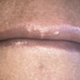 Two permanent pimple like  injection marks. This is the Botox injection area