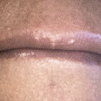 InjectAbility Clinic - Two permanent pimple like  injection marks. This is the Botox injection area - Skin Care Near Me - Torrance, California