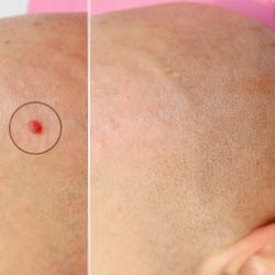 Eleyyc - Cherry Angioma aka Ruby Point Removal
